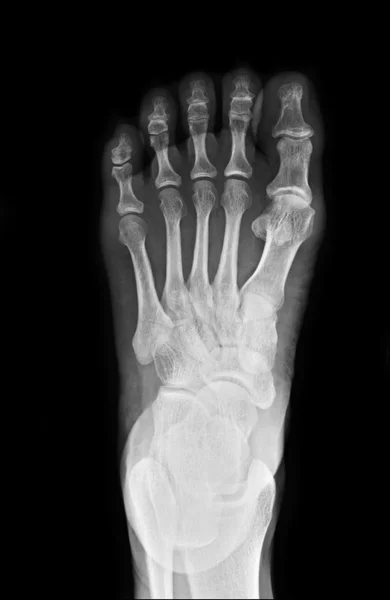 X-ray of foot — Stock Photo, Image