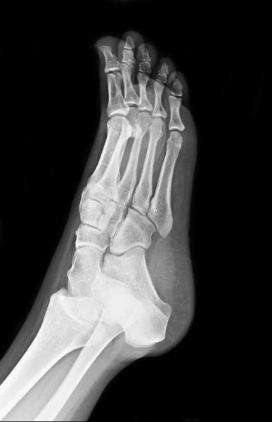 Röntgen av foten — Stockfoto