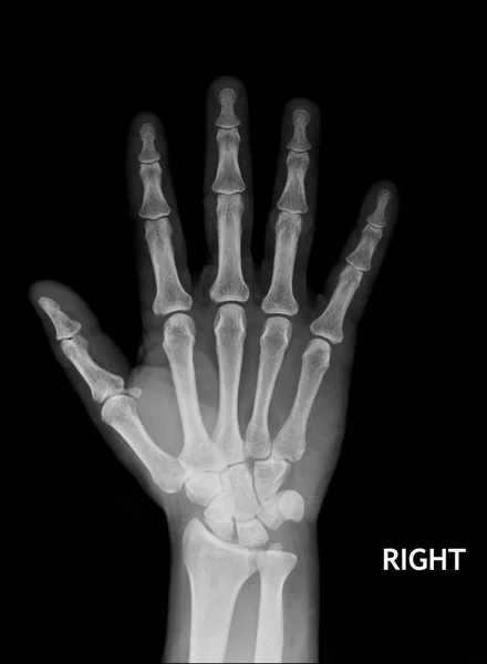 X-Ray Hand. — Stock Photo, Image