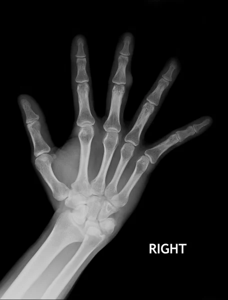 X-Ray Hand. — Stock Photo, Image