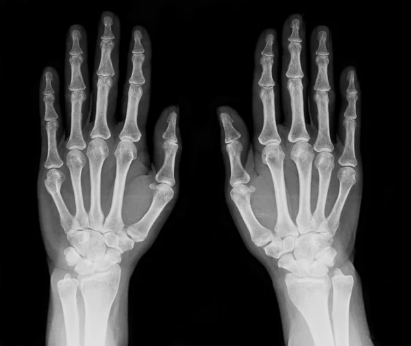 Mano de rayos X . — Foto de Stock
