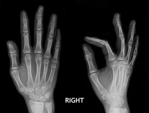 Рентген рук . — стоковое фото