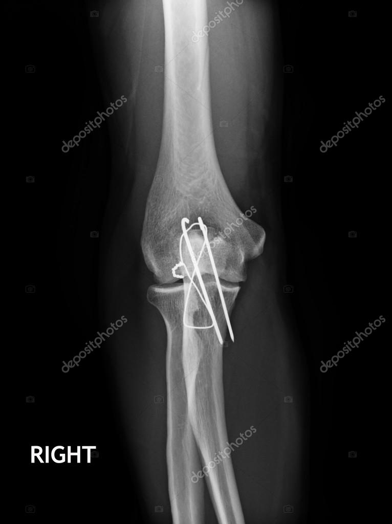 Fracture Elbow, forearm xrays image showing plate and screw fixation