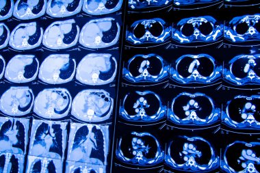 Araştırma tıp. CT taraması hastanın.