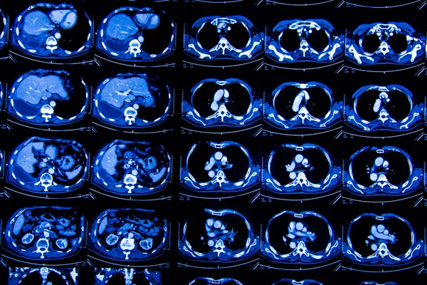 Araştırma tıp. CT taraması hastanın.