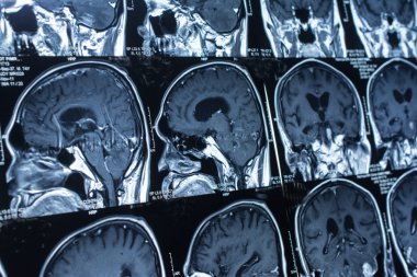 Araştırma tıp. CT taraması hastanın.