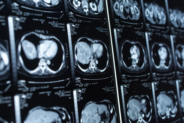 Araştırma tıp. CT taraması hastanın.