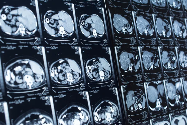 Araştırma tıp. CT taraması hastanın.