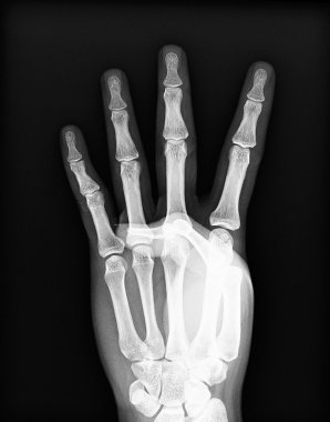Her iki insan eli x-ray