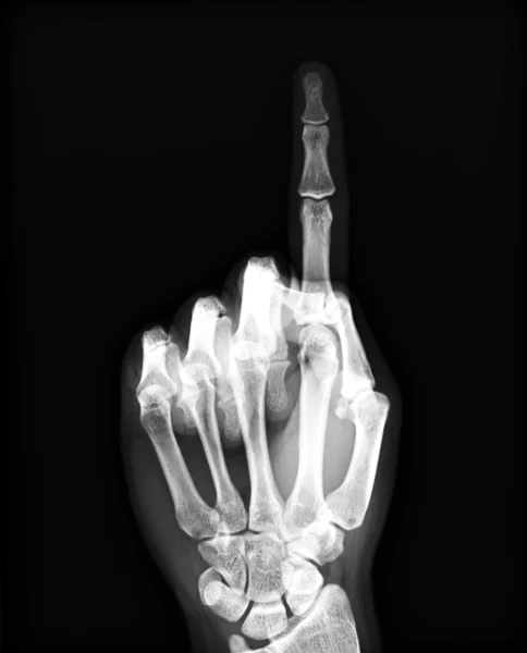 X-ray of both human hand — Stock Photo, Image