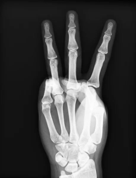 X-ray of both human hand — Stock Photo, Image