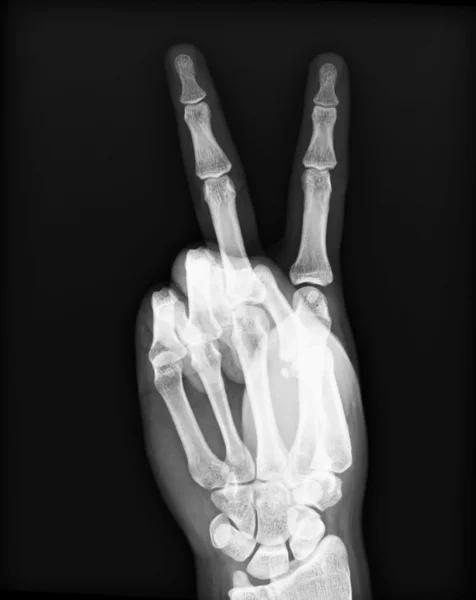 Ακτινογραφία των δύο ανθρώπινο χέρι — Φωτογραφία Αρχείου