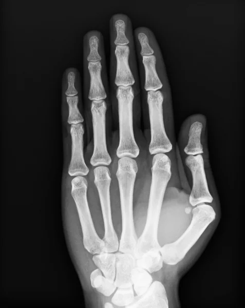 X-ray of both human hand — Stock Photo, Image