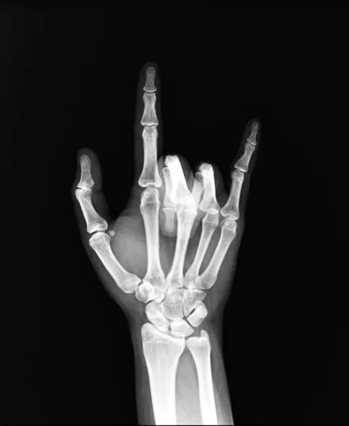 X-ray of both human hand — Stock Photo, Image