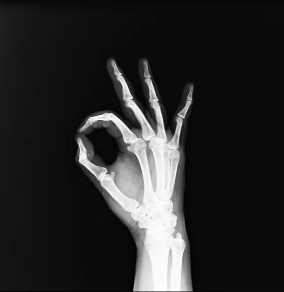 Рентген обеих человеческих рук — стоковое фото