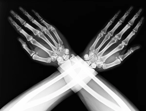 X-ray of both human hand — Stock Photo, Image