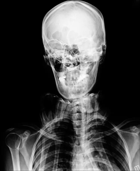 X-ray picture of the skull — Stock Photo, Image