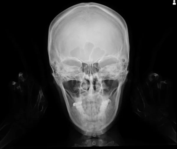 Рентгеновский снимок черепа — стоковое фото