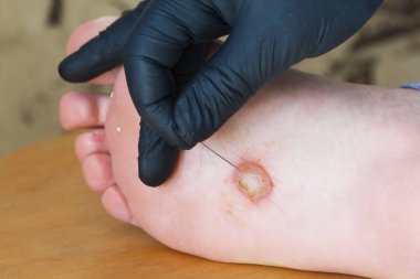 Ayağında dishidrotik egzama var. Kabarcık dermatiti. Eldivenli bir el bir mızrak aleti tutar. Yakın çekim..