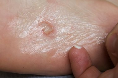 Ayağında dishidrotik egzama var. Kabarcık dermatiti. Merhemle tedavi edilir. Yakın çekim..