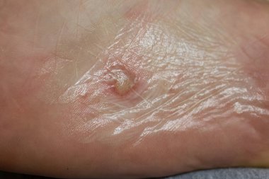 Ayağında dishidrotik egzama var. Kabarcık dermatiti. Merhemle tedavi edildi. Yakın çekim..