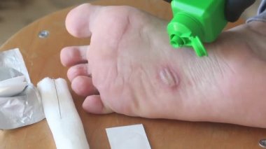 Ayağında dishidrotik egzama, dermatit. Bir adam sönmüş bir mesaneyi alkolle tedavi eder. Yakın çekim..
