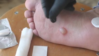 Ayağında dishidrotik egzama, dermatit. Adam baloncuğu iğneyle deliyor. Yakın çekim..