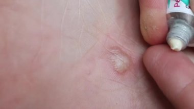 Ayağında dishidrotik egzama, dermatit. Adam merhemi parmağına sıkıyor ve etkilenen bölgeye uyguluyor. Yakın çekim..