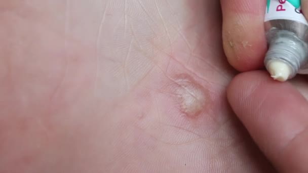 Eczema dissidrótico no pé, dermatite. O homem espreme a pomada no dedo e aplica-a na área afetada. Imagem de close-up. — Vídeo de Stock