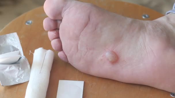 Eczema dissidrótico no pé, dermatite. O homem trata a bexiga com álcool antes de perfurar. Imagem de close-up. — Vídeo de Stock