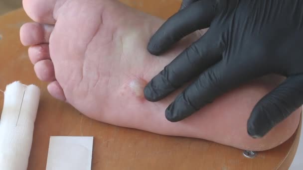 Wyprysk dyshidrotyczny na stopie, zapalenie skóry. W pobliżu znajduje się bandaż i tynk do przetwarzania. Strzał z bliska. — Wideo stockowe