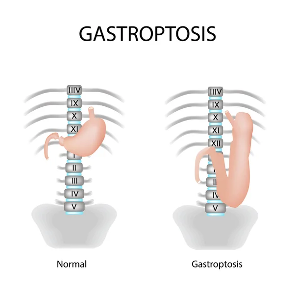 Gastroptosis gyomor. A mulasztás a gyomor. Szakasz gastroptosis. Elszigetelt háttér vektor illusztráció — Stock Vector