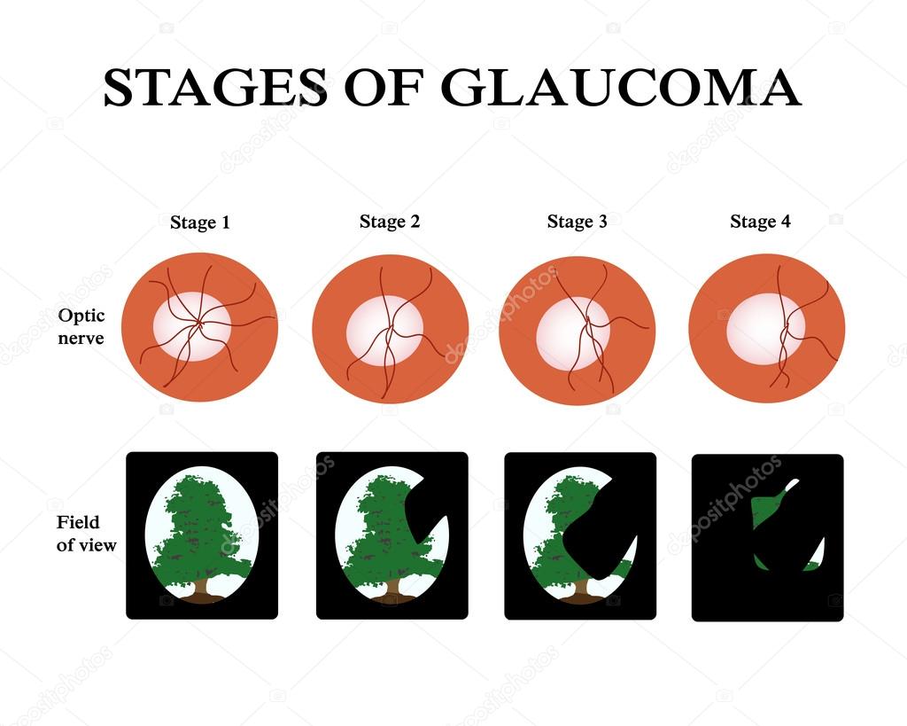 Glaucoma. The field of vision in glaucoma. Atrophy of the optic nerve. Infographics. Vector illustration on isolated background
