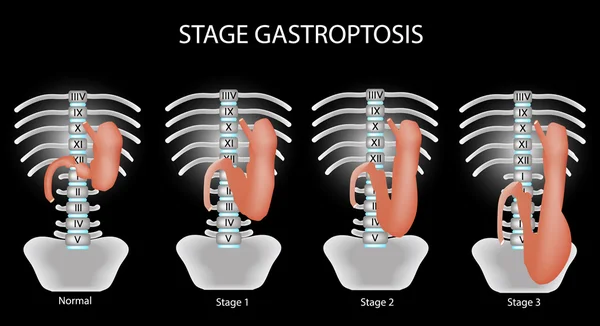 Gastroptosis estomacal. La omisión del estómago. Gastroptosis en estadio. Ilustración vectorial sobre fondo negro — Archivo Imágenes Vectoriales
