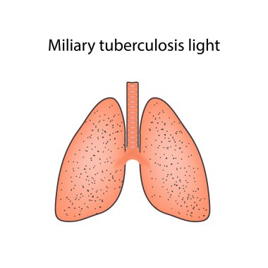 Miliaria tüberkülozu. Vektör illüstrasyon izole arka plan üzerinde