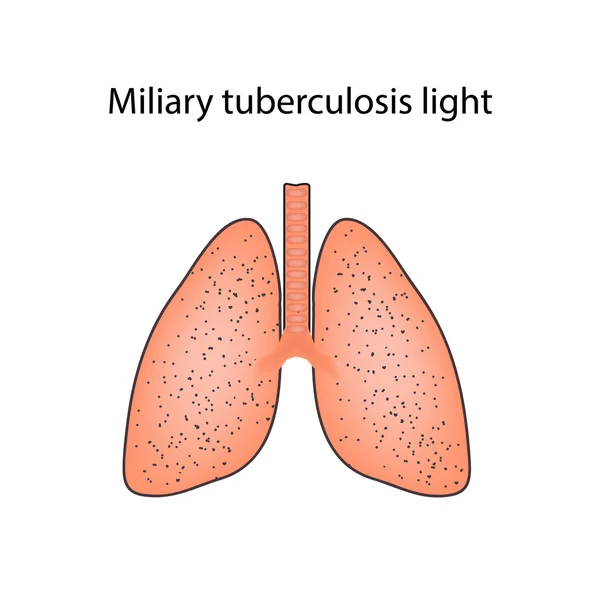 Tuberculosis miliar. Ilustración vectorial sobre fondo aislado — Archivo Imágenes Vectoriales