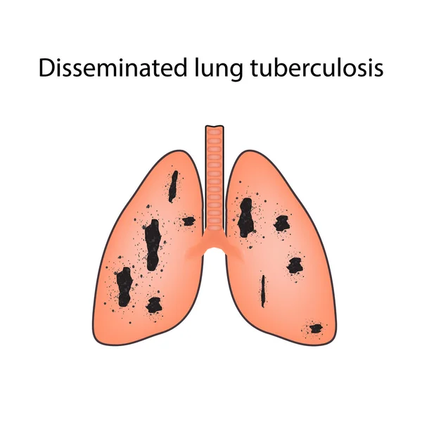Tuberculose disseminada. Ilustração vetorial sobre fundo isolado — Vetor de Stock
