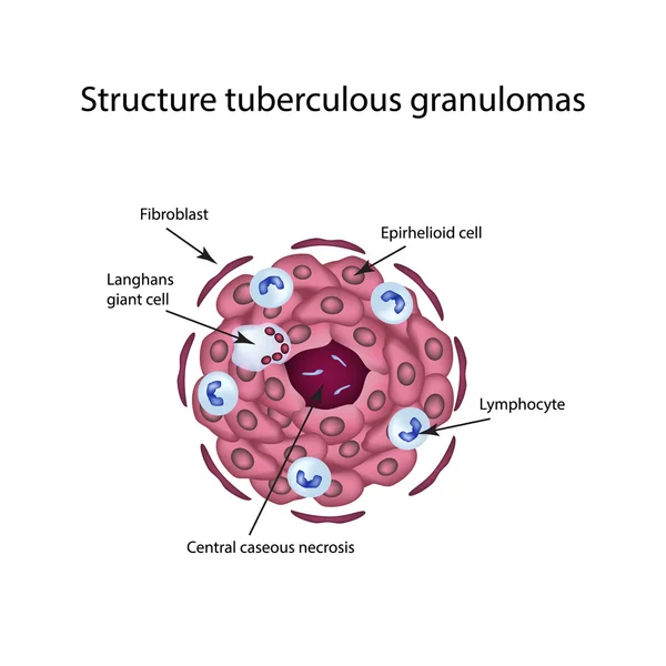 Estructura de los granulomas tuberculosos. Ilustración vectorial sobre fondo aislado — Archivo Imágenes Vectoriales