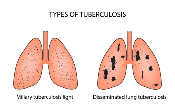 Tüberküloz türleri. Miliari ve Dissemine akciğer tüberkülozu. Vektör illüstrasyon izole arka plan üzerinde — Stok Vektör