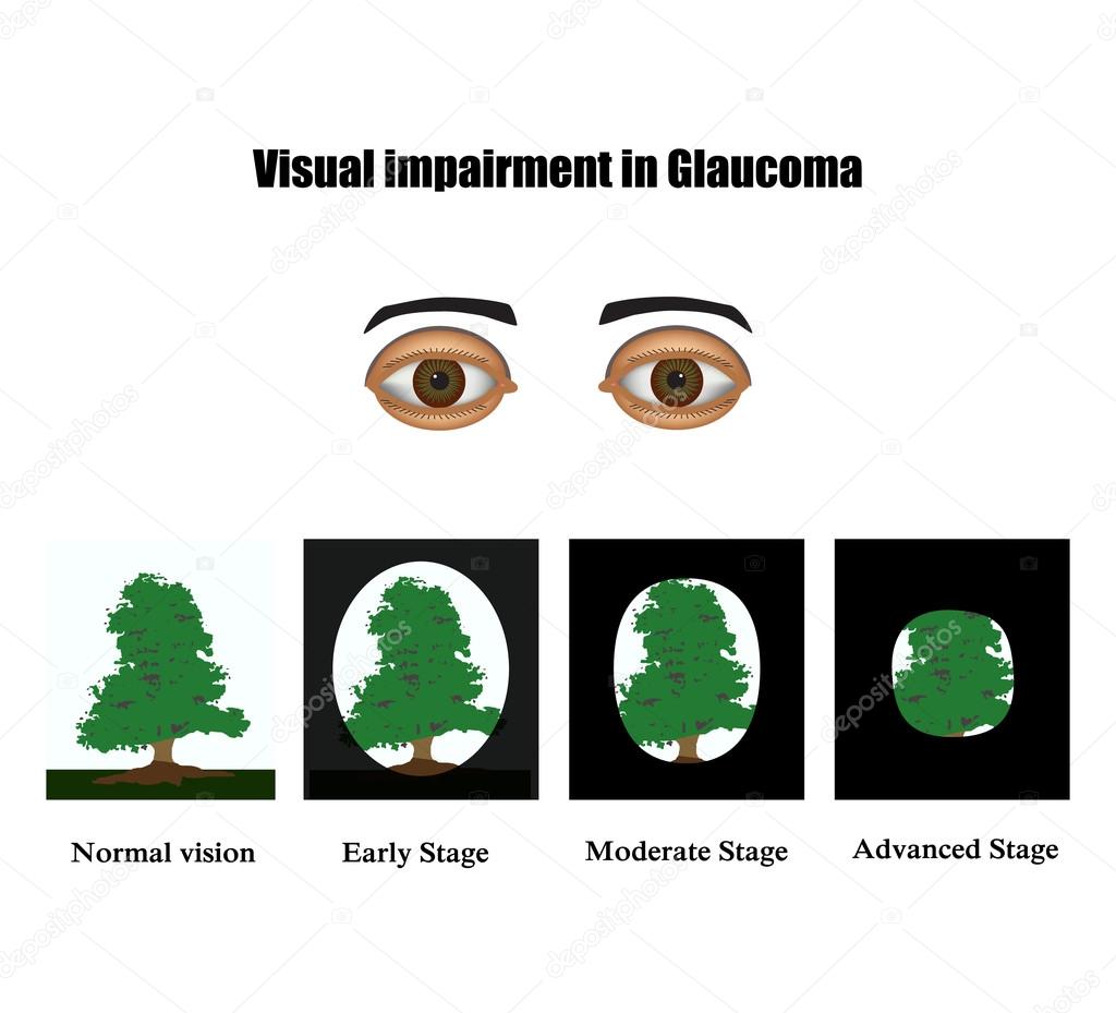 Glaucoma. The field of vision in glaucoma.  Infographics. Vector illustration on isolated background