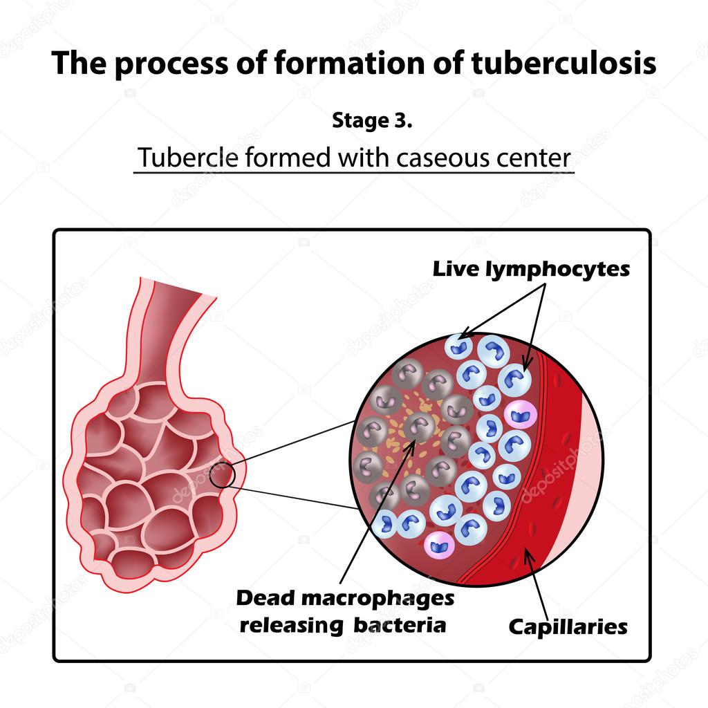 The development of tuberculosis. Stage 3. Infographics. Vector illustration on isolated background
