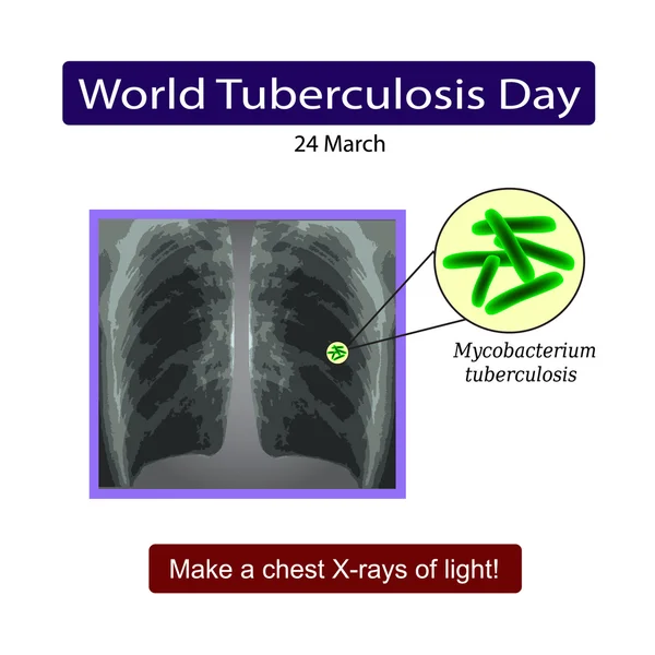 X-stralen van het licht. Diagnose van tuberculose. Vectorillustratie op geïsoleerde achtergrond — Stockvector