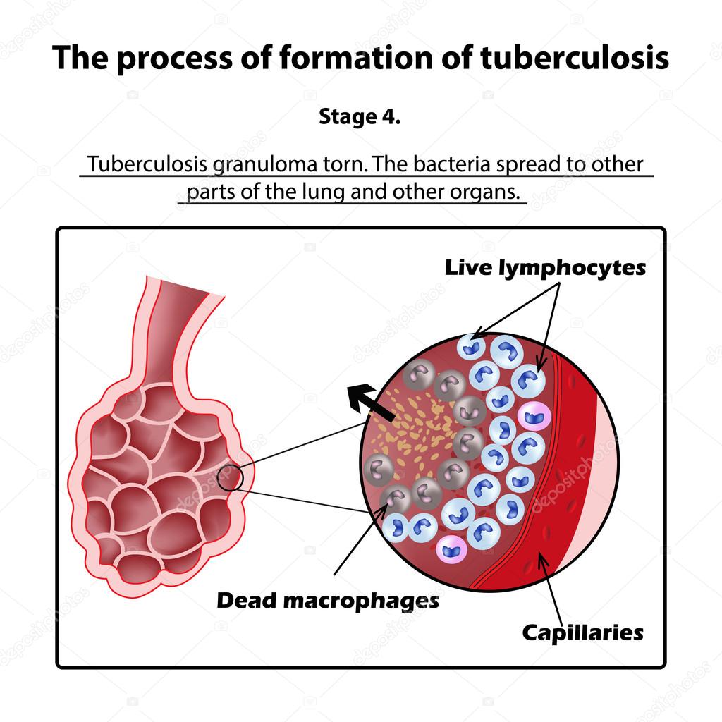 The development of tuberculosis. Stage 4. Infographics. Vector illustration on isolated background