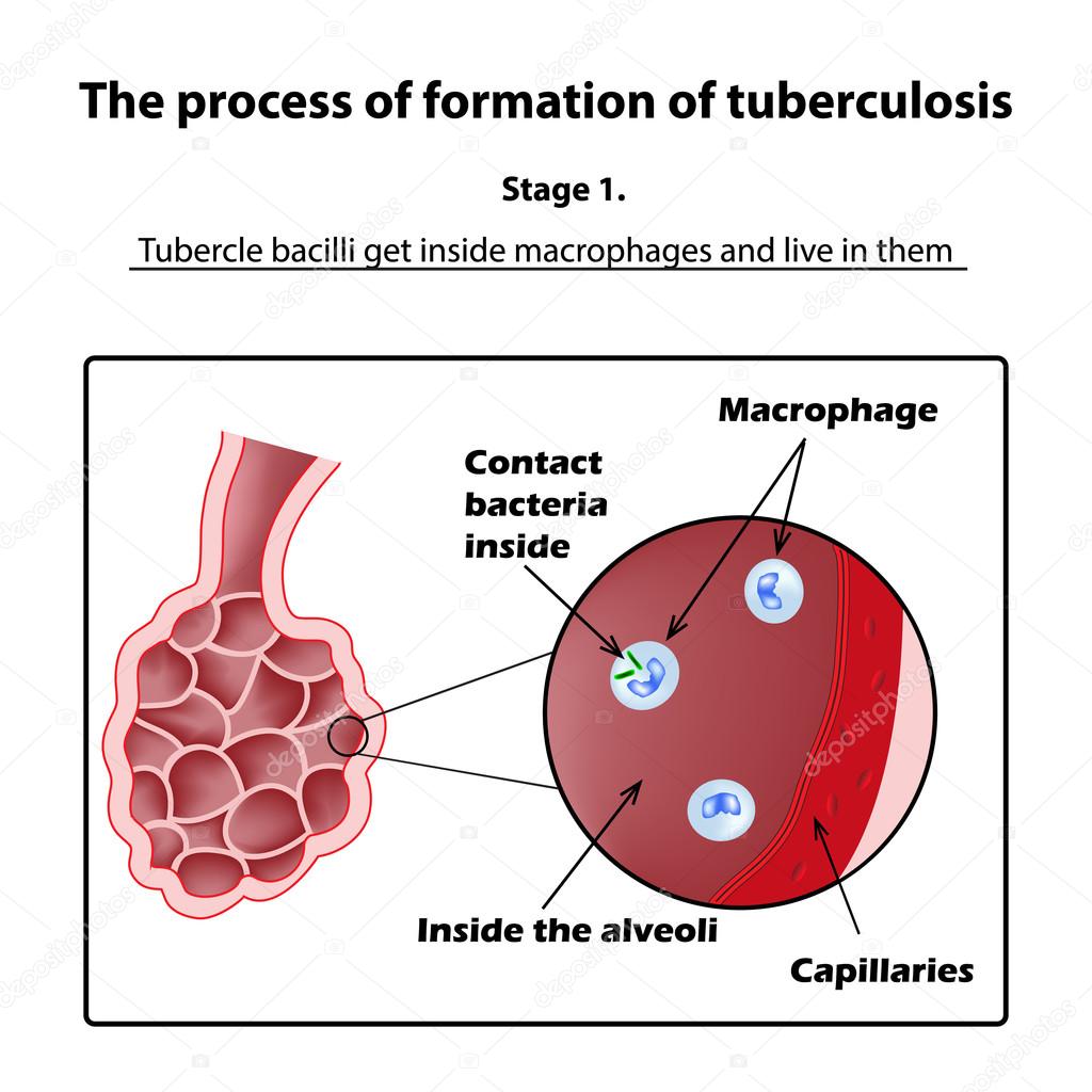 The development of tuberculosis. Stage 1. Infographics. Vector illustration on isolated background