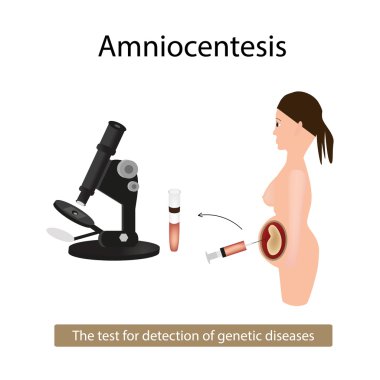 Amniyosentez. Amniyotik sıvı analizi. Hamile kadın. Genetik hastalıklar. Vektör illüstrasyon izole arka plan üzerinde
