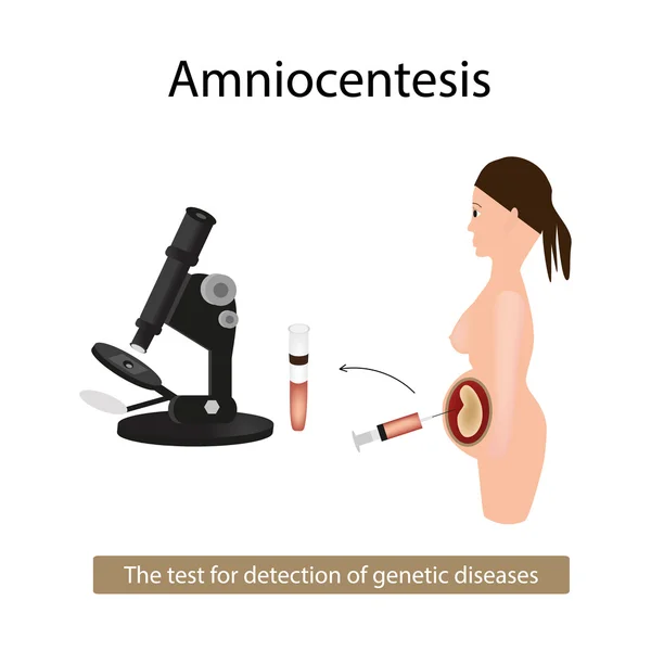 Amniocentézis. Elemzés a magzatvíz. Terhes nő. Genetikai betegségek. Elszigetelt háttér vektor illusztráció — Stock Vector