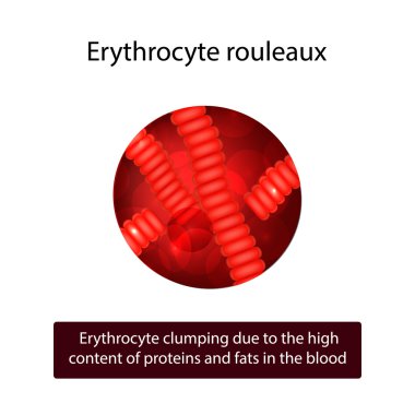 Rouleaux of red blood cells. Erythrocyte clumping due to the high content of proteins and fats in the blood.  clipart