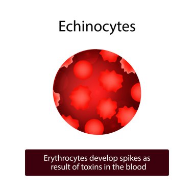 Echinocytes. Eritrositler ani kan toksinler sonucunda gelişir. Vektör illüstrasyon izole arka plan üzerinde