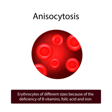 Anisocytosis. Kırmızı kan hücreleri B vitaminleri, demir ve folik asit eksikliği nedeniyle farklı boyutlarda. 
