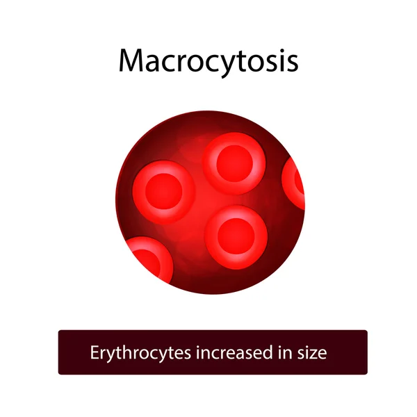 Macrocytes. Ερυθρά αιμοσφαίρια αυξάνονται σε μέγεθος. Vector εικονογράφηση σε απομονωμένες φόντο — Διανυσματικό Αρχείο